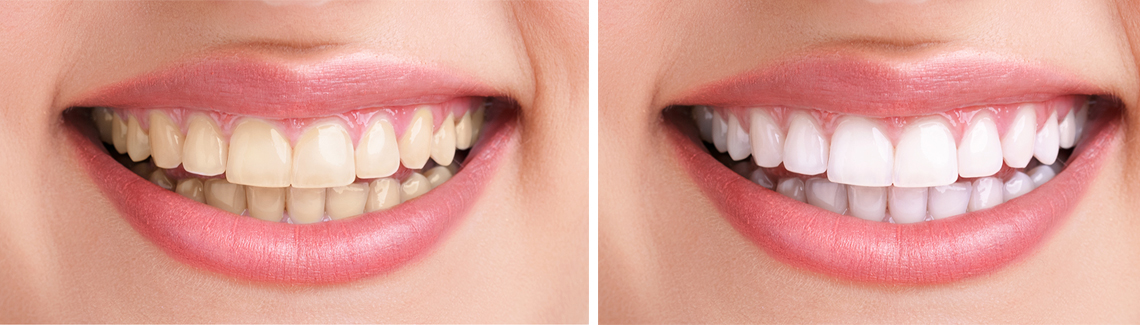 Bleaching Treatment Bleaching Treatment