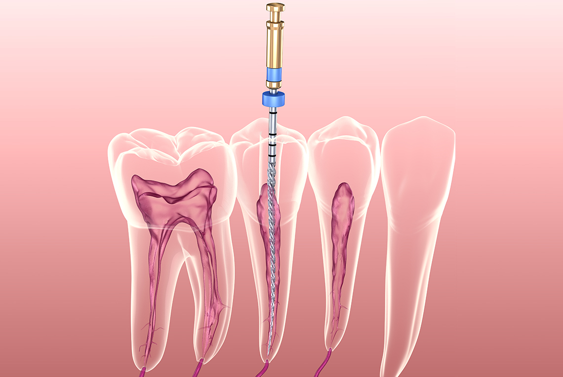 Endodontics Endodontics